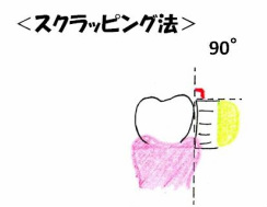 スクラッピング法