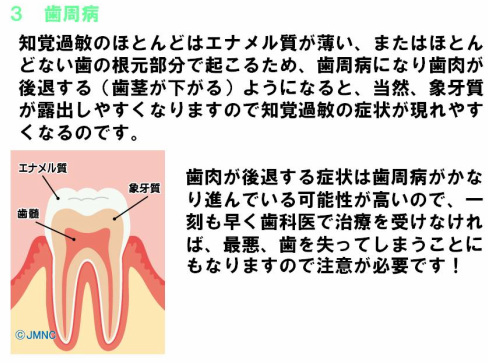 知覚過敏の原因3