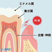 知覚過敏