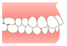 不正咬合