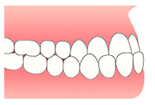不正咬合