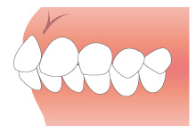 不正咬合